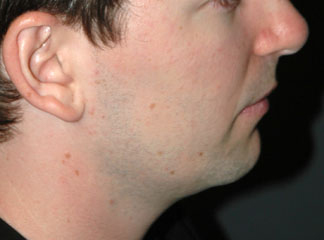 chin implant male before photo patient